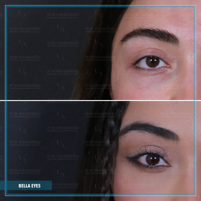Is Bella Eyes® Permanent?