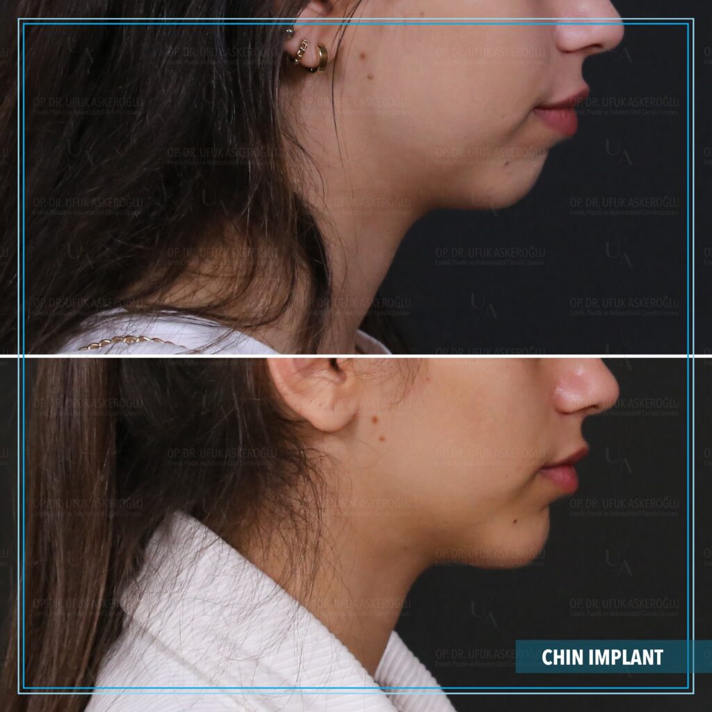 chin implant surgery Turkey