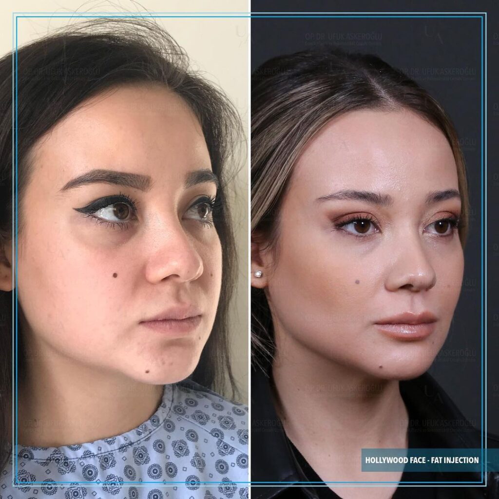 Hollywood Face Surgery