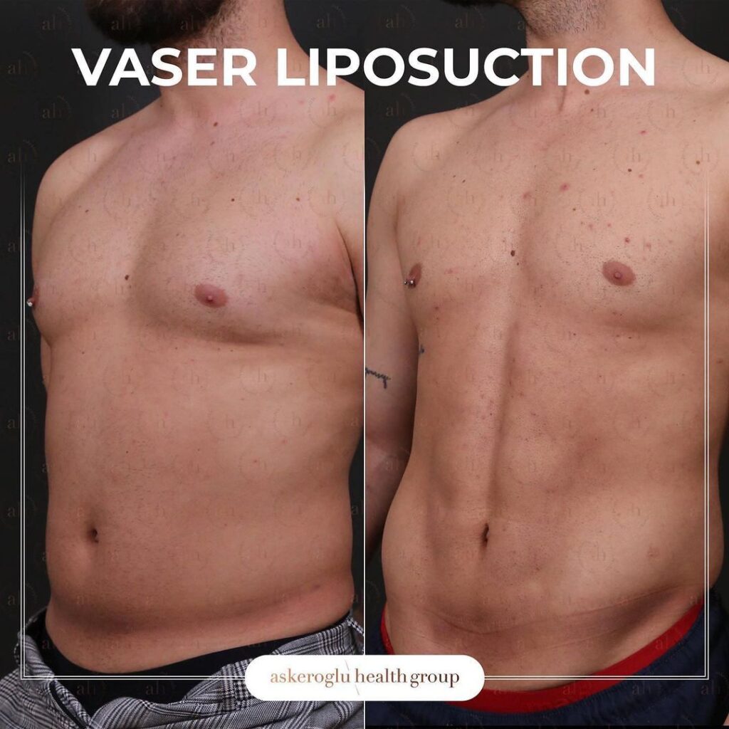 (Yağ Aldırma) Vaser Liposuction