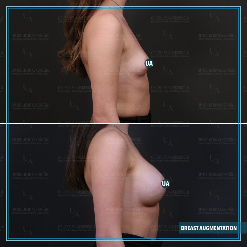 breast augmentation (breast implants)
