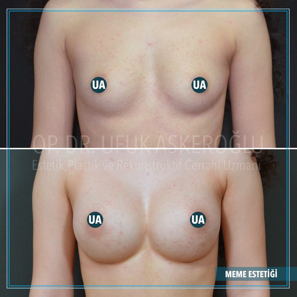 Implants mammaires en Turquie