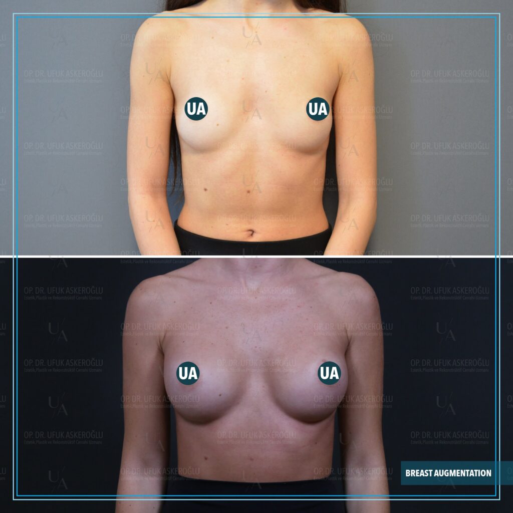 Implants mammaires en Turquie