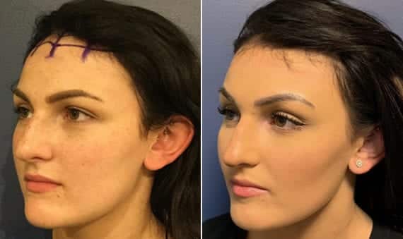 Reducción de frente Turquía