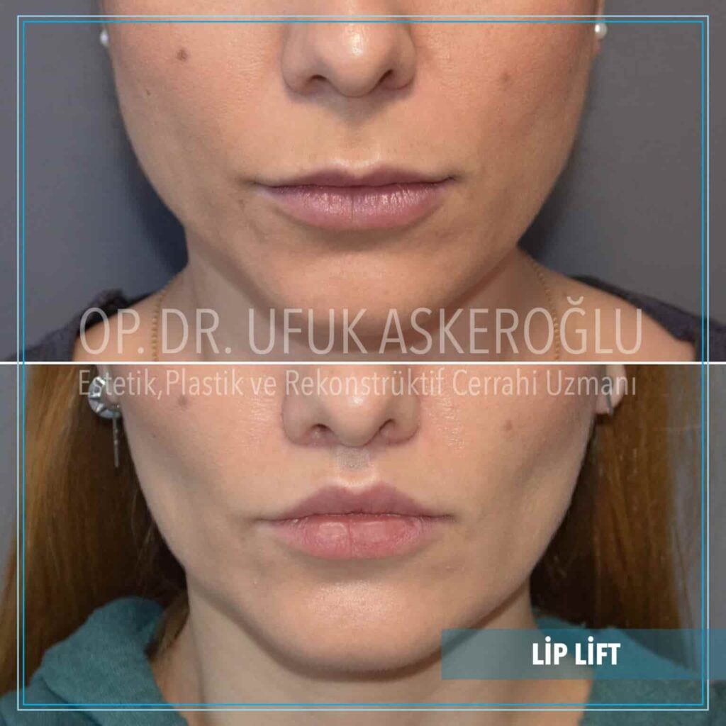 Lip-Lift-1-1536x1536