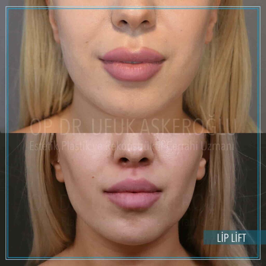 Lip-Lift-6-1536x1536