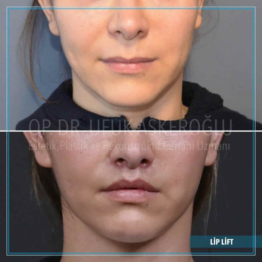 Lip-Lift-8-1536x1536