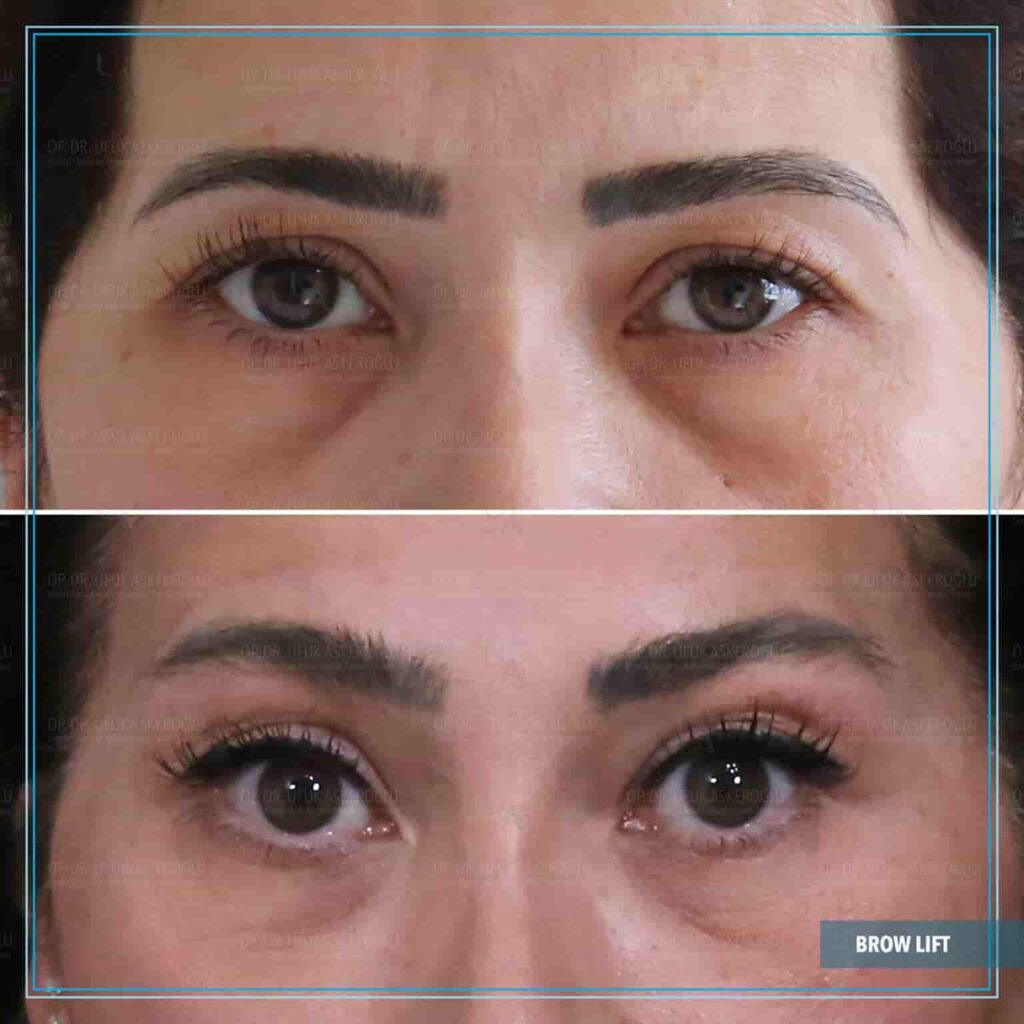Medial-Brow-Lift-1-1536x1536